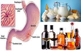 Food can't cause an ulcer. List Of Foods To Avoid If You Have Stomach Ulcers Inminutes Magazine