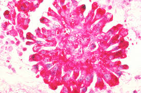 Image result for Sarcoma