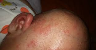 Apabila bintik merah pada kulit bayi muncul tanpa disertai dengan gejala yang lainnya, mungkin saja bayi mengalami ruam ringan yang akan hilang dengan sendirinya setelah dilakukan perawatan yang tepat. Ketahui Jenis Bintik Merah Pada Kulit Bayi Umahliyu