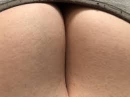Symptoms of inflammatory breast cancer may include: Inflammatory Breast Cancer Breast Cancer And Screening Forums Patient