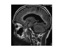 Multiple sklerose (ms) verläuft bei jeder/jedem betroffenen anders. Patient Mit Multipler Sklerose Multiple Herdlasionen Periventrikular Sagittales Flair Bild Praxis Fur Neurologie Frankfurt A M