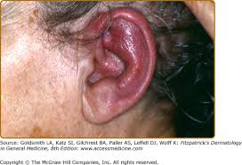 Image result for Relapsing Polychondritis
