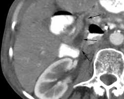 Image result for Choledocholithiasis