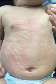 Image result for Urticaria pigmentosa children