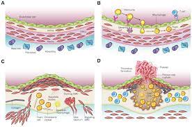 Cardiovascular Diseases Related To Ionizing Radiation The Risk Of Low Dose Exposure Review