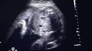An ultrasound is usually done for all pregnant women at 20 weeks. 30 Weeks Pregnant Ultrasound Video Youtube