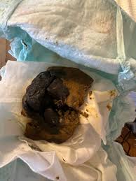 Image result for dark black stool human poop