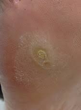 Verrugas Plantares Pedipedia Enciclopedia Pediatrica Online