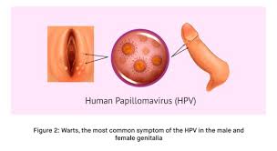 Image result for human papillomavirus symptoms