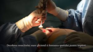 A naples, trois gangsters américains synopsis et détails. Video Operatie De Dubla Mastectomie Cu Reconstructie Imediata Medlife