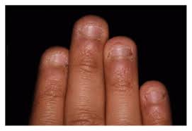 What Does Nail Biting Mean And How To Stop 3 Killer Ways Get Long Nails