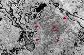Lim han boon content, pages, accessibility, performance and more. Neuropathology Of The Alzheimer S Continuum An Update
