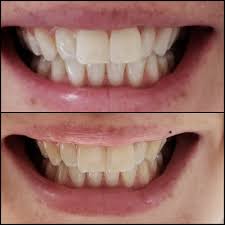 To help maintain the whitening effects of your treatment, your dentist may advise you to avoid certain foods and beverages, or consume them in moderation to avoid staining your teeth. The Cost Of Teeth Whitening In Cali Colombia Dental Tourism Colombia Dental Tourism Colombia