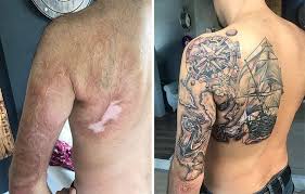 Mole Birthmark Tattoo Cover Up Pin On Medical Tattoo S