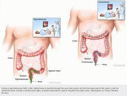 Learn more about the symptoms, causes, diagnosis, and treatment of diverticulitis at if you have them, it's called diverticulosis. Diverticular Disease Expanded Version Ascrs
