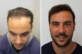 Get a better hair transplant from our hair restoration surgeons \ hair transplant results video. Hairline Correction After An Fut Cyril S Fue2 Hair Transplant Hairpalace