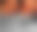 Image result for Colonoscopy in GI Bleeding