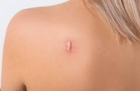 Image result for Keloid