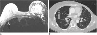 Inflammatory breast cancer (ibc) is rare, making up about 2 to 4 percent of breast cancer cases. 52 Year Old Female With Left Breast Cancer With No Changes In Solitary Download Scientific Diagram