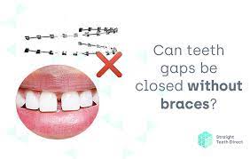 This is easy enough a reason not to do it yourself. Teeth Gaps Can They Be Closed Without The Use Of Braces