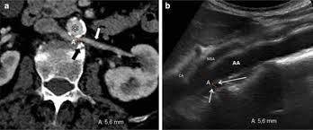 Posterior Nutcracker Syndrome A Case Report Journal Of Medical Case Reports Full Text