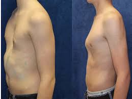 Image result for Pectus Excavatum