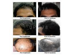 It contains an enzyme that is capable of converting testosterone into dht, the hormone that is responsible for hair loss in mind. Best Hair Treatments In India For Hair Loss Hair Fall In Men Women Hair Growth Solution By The Esthetic Clinics
