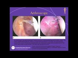 Dear friends and fans, for one month you will be able to download our albums for free from casus belli musica. Humeral Avulsion Of The Glenohumeral Ligament Hagl Lesion Youtube