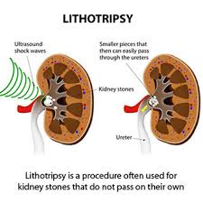 Kidney Stones Pain Symptoms Causes Passing A Kidney Stone Treatment About 15% of kidney stones will require intervention. kidney stones pain symptoms causes
