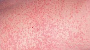 Image result for MEASLES