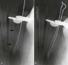 Check spelling or type a new query. Endodontic Radiography Pocket Dentistry
