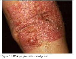 Image result for dermatitis contacta