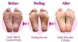 Cracked Feet And Hard Dry Skin On Feet What Can You Do About Dead Skin How Can You Remove It It S Eas In 2020 Dry Skin On Feet Healthy Skin
