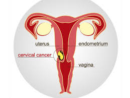 Cancer can cause different symptoms, such as abnormal bumps, night sweats, or unexplained weight gain or loss. à®ª à®£ à®à®³ à®© à®à®° à®ª à®ªà®ª à®ª à®¯ à®² à®à®± à®ªà® à®® à®ª à®± à®± à®¨ à®¯ à®¤à® à®ª à®ªà®¤ à®à®ª à®ªà® Cervical Cancer Causes Symptoms And Prevention Methods Tamil Boldsky