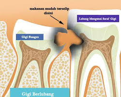 Maybe you would like to learn more about one of these? Biaya Operasi Gigi Bungsu Audy Dental