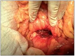 Resultado de imagen para pseudoquiste en   pancreatitis