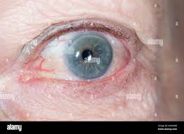 Image result for Proptosis