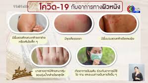 ผื่น 5 แบบ ที่แพทย์คิดว่าอาจเป็นอาการจากไวรัสโคโรนา 4 พฤษภาคม 2020 Pkrf4o Vxt J2m