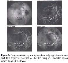 The most common sites for breast cancer to spread to are the bones, lungs, liver, lymph nodes, adrenal gland. Choroidal Metastasis As A First Sign Of Recurrence In A Patient With Breast Cancer A Case Report
