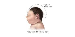 facts about microcephaly cdc