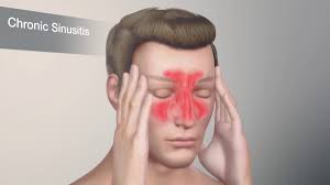 Discover which are the most common food allergies and how to avoid eating them in your foods. What Allergies Cause Sinus Problems Allergy Asthma Sinus Center P C