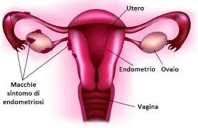 However, in rare cases it may also occur in other parts of the body. I Principali Sintomi Dell Endometriosi Vivere Piu Sani