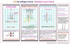 Yes, criteria for rbbb is present. Lvh By Voltage Criteria Sokolow Lyon Index Diagnosis Grepmed