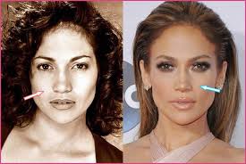 Jennifer Lopez Cheek Implants Plastic Surgery Before And After Rhinoplasty Before And After Celebrity Surgery Cheek Implants