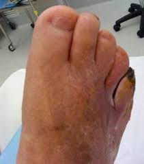 Image result for toe amputation