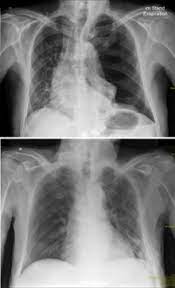 Pneumothorax ⸺ time for new guidelines? Spannungspneumothorax Wikipedia