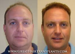 Celebrity Hair Transplant Clinic For Men And Women in Alabama Jackson  Padgett