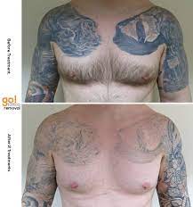 This Client Brought A Huge Project To Us Fade Both Half Sleeves And Chest Plates So They Could Be Covered And Tattoo Removal Laser Tattoo Removal Laser Tattoo