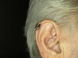 Image result for cornu cutaneum)