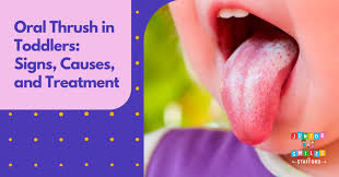 Image result for Oral thrush roof of mouth